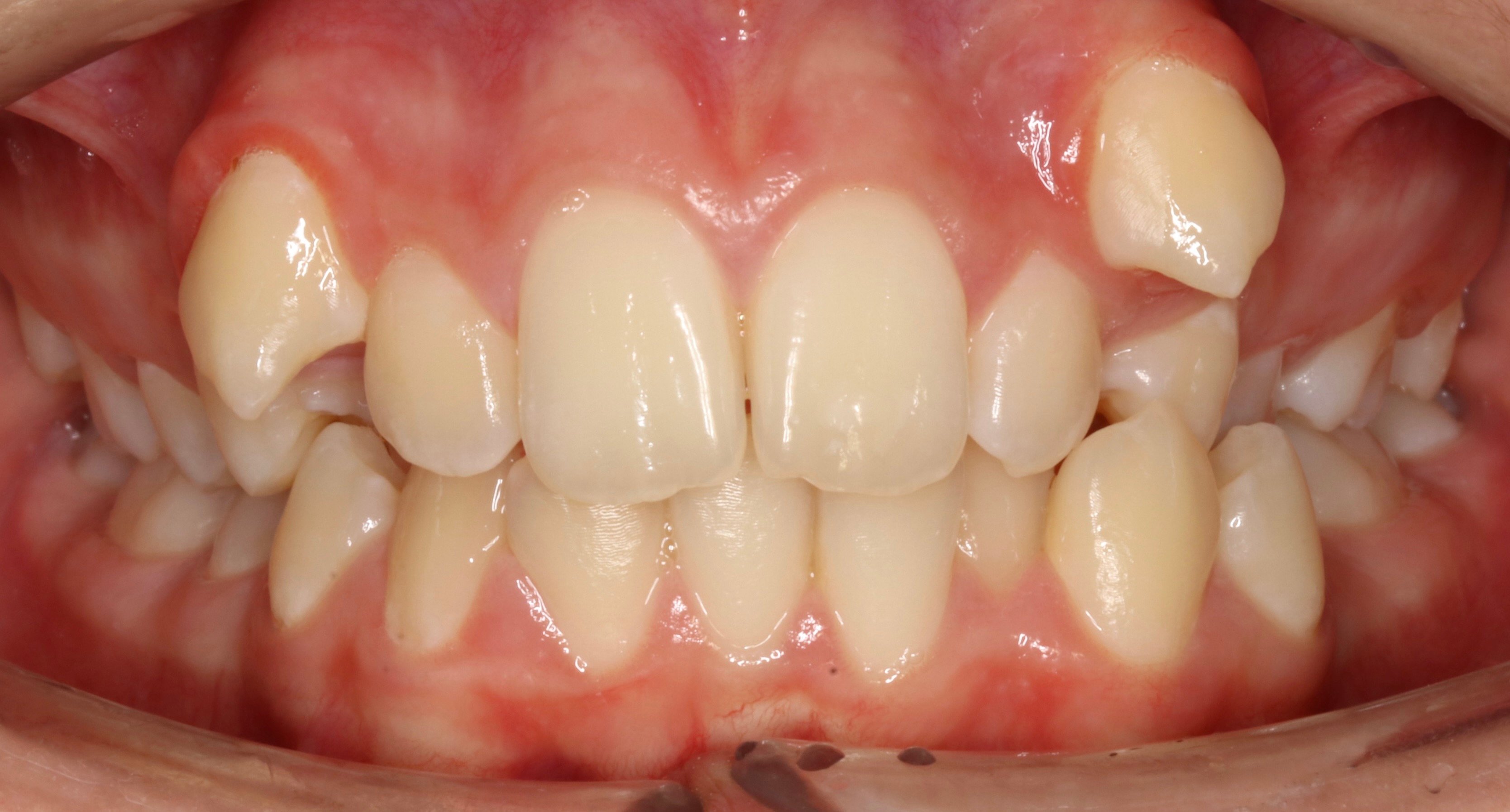 Fixed Braces Nottingham The Campbell Clinic